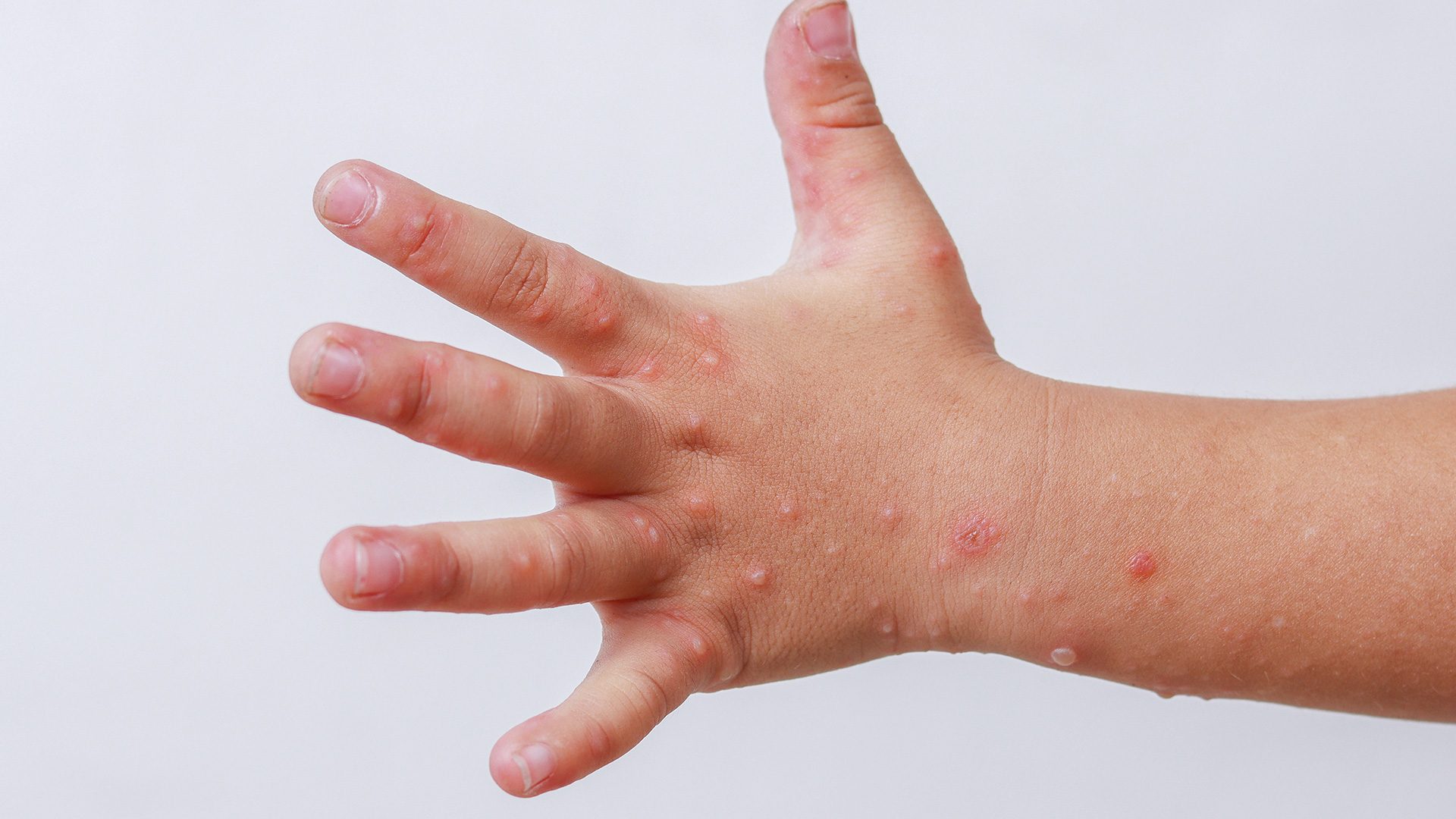 Hand, Foot, And Mouth Disease: An Overview, 42% OFF - Waterpokken Of Hand Voet Mondziekte