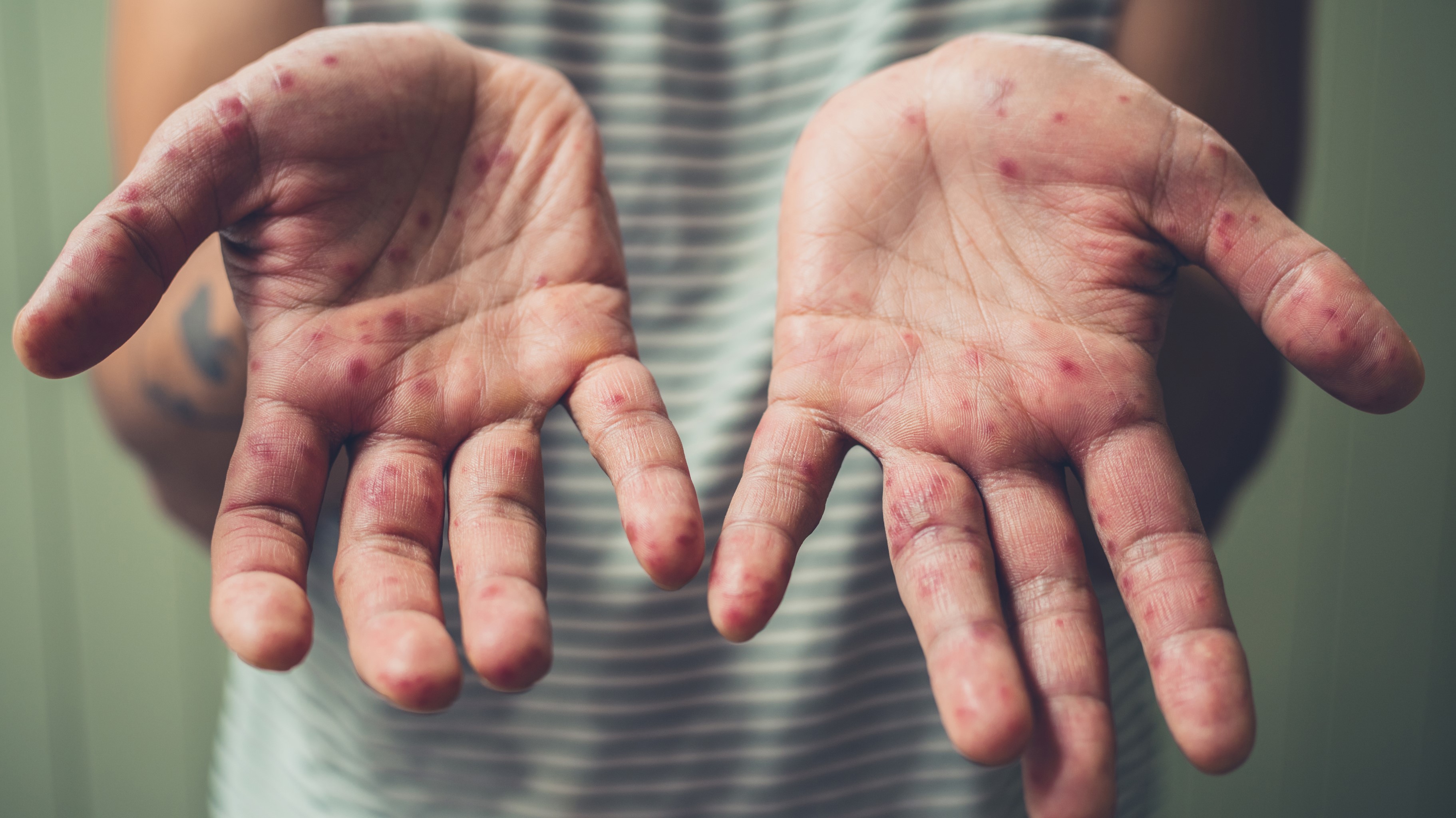 Hand, Foot, and Mouth Disease (HFMD) | Pediatric Associates of - Verschil Waterpokken En Hand Voet Mondziekte