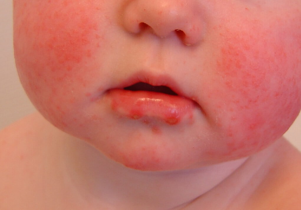 hand foot mouth disease baby - pictures, photos - Verschil Waterpokken En Hand Voet Mondziekte