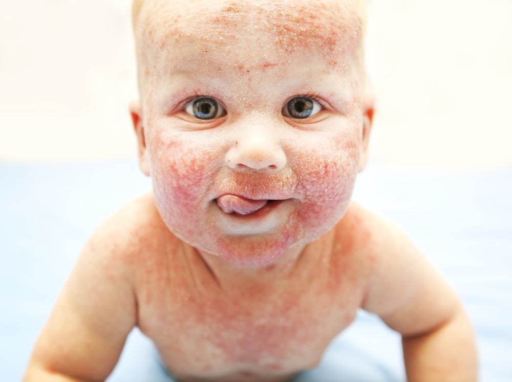 Hard water may increase eczema risk in infants, study says - UPI.com - Verschil Atopisch En Constitutioneel Eczeem