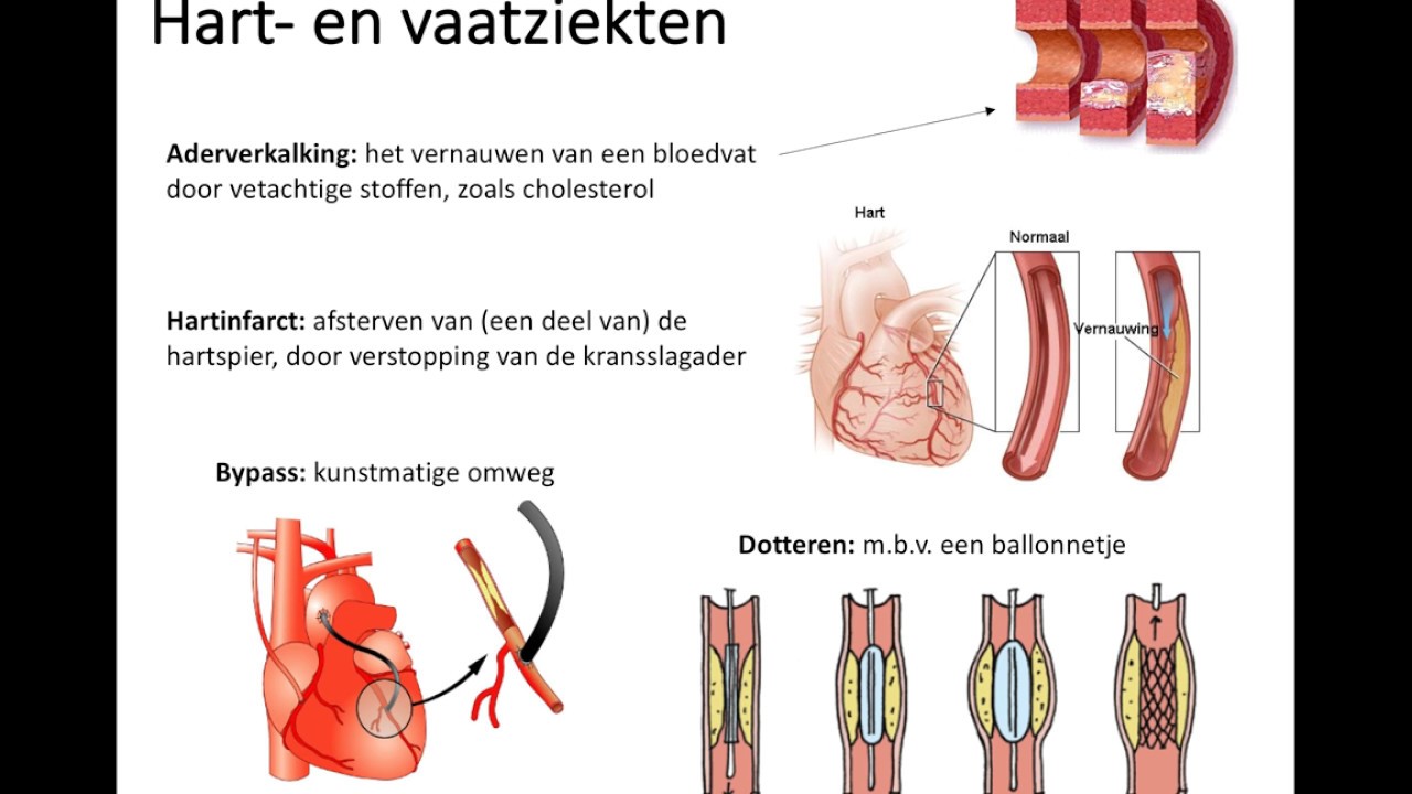 Risicofactoren Voor Hart En Vaatziekten