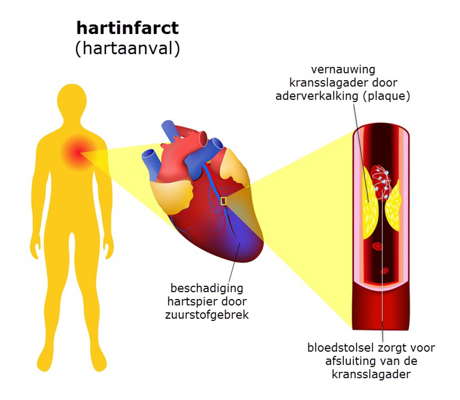Hartinfarct Oorzaken Symptomen Diagnose Complicaties En Behandeling - Wat Gebeurt Er Bij Een Hartinfarct