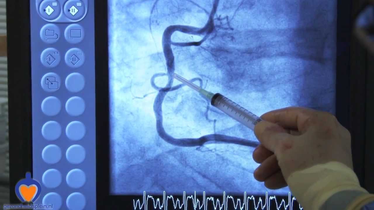 Hartkatheterisatie & Dotter- en stentbehandeling - YouTube - Wat Is Een Stent Hart