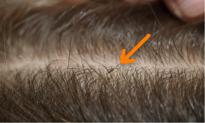 Head lice diagnosis: At the clinic or at home | Lice Clinic Europe - Hoe Ziet Een Koortslip Eruit