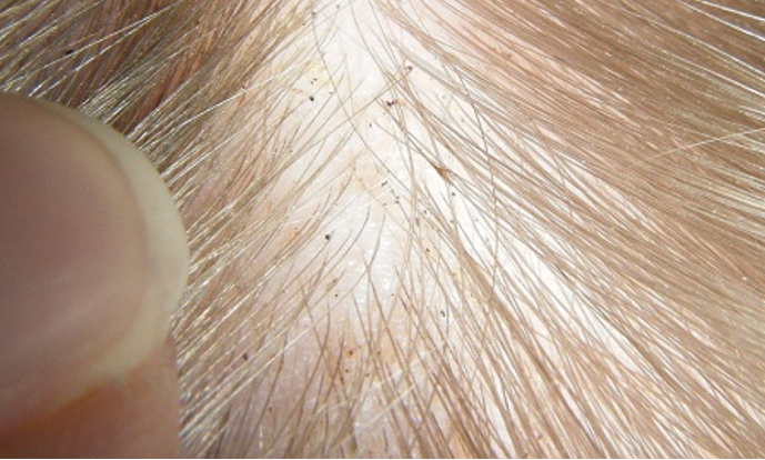 Head lice diagnosis: At the clinic or at home | Lice Clinic Europe - Hoeveel Haren Zitten Er Op Je Hoofd