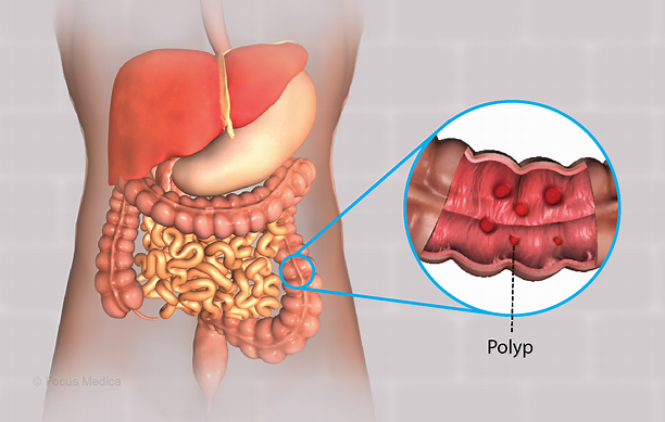 Health Condition : Symptoms, Causes, Treatment and More - Hoe Ontstaan Poliepen In De Darmen