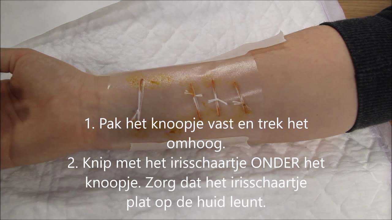 Hechtingen verwijderen - YouTube - Wanneer Pleister Verwijderen Na Hechting