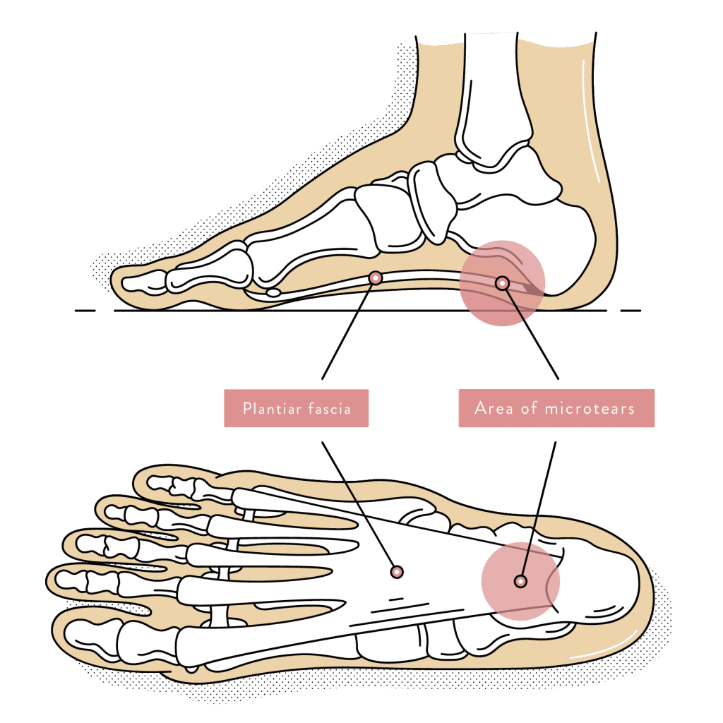 Heel Pain | Causes, Types and Podiatry Treatment - Heel Getal Delen Door Breuk