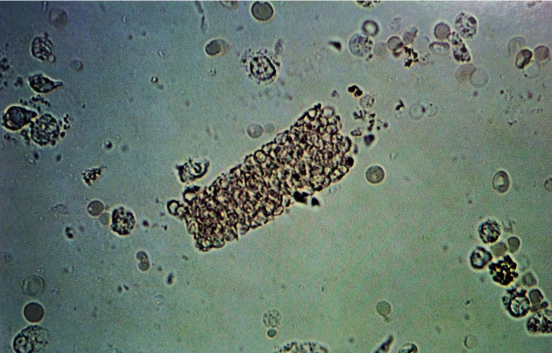 HEMATOLOGY - Leukocyten En Erytrocyten In Urine