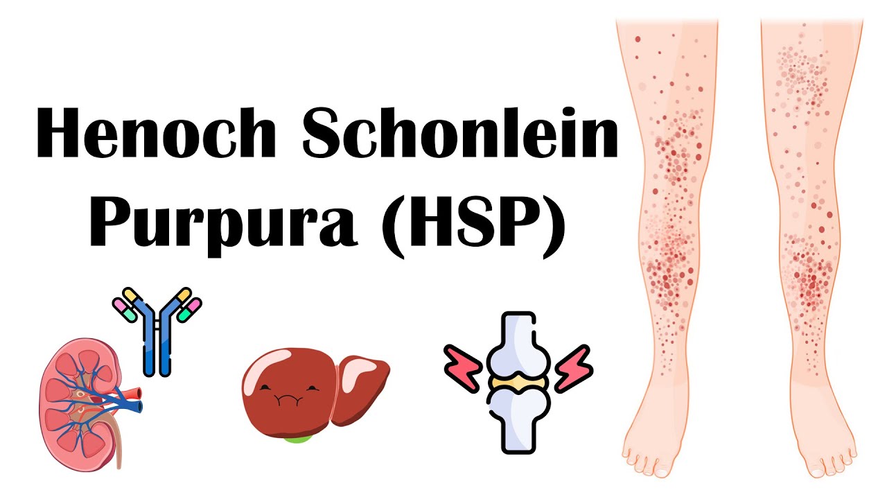 Henoch Schoenlein Purpura (HSP) - Causes, Pathophysiology, Diagnosis - Ziekte Van Henoch Schonlein Ervaringen