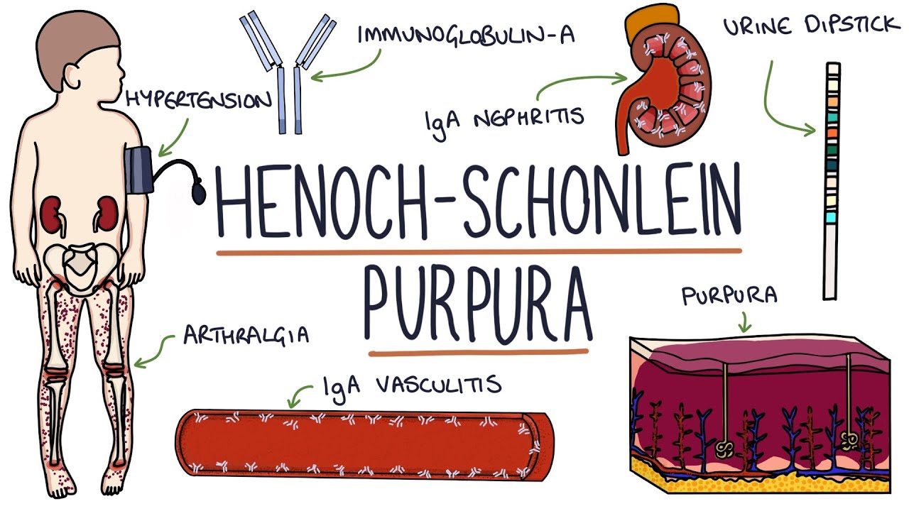 Henoch-Schonlein Purpura: Visual Explanation for Students - YouTube - Ziekte Van Henoch Schonlein Ervaringen