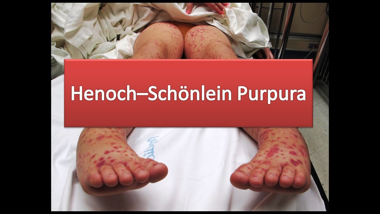 Ziekte Van Henoch Schonlein Ervaringen