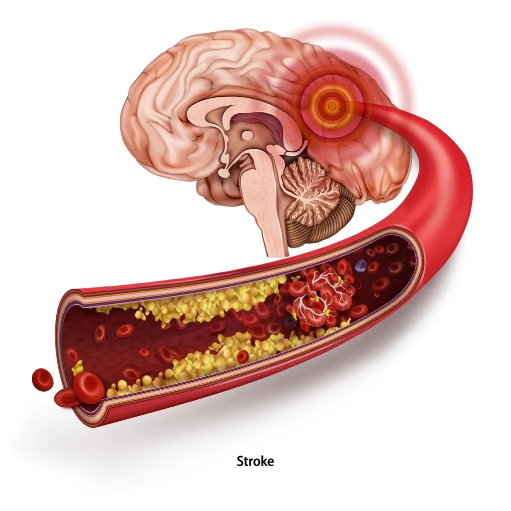 Herseninfarct & hersenbloeding - Hoofdpijn En Duizelig Na Herseninfarct