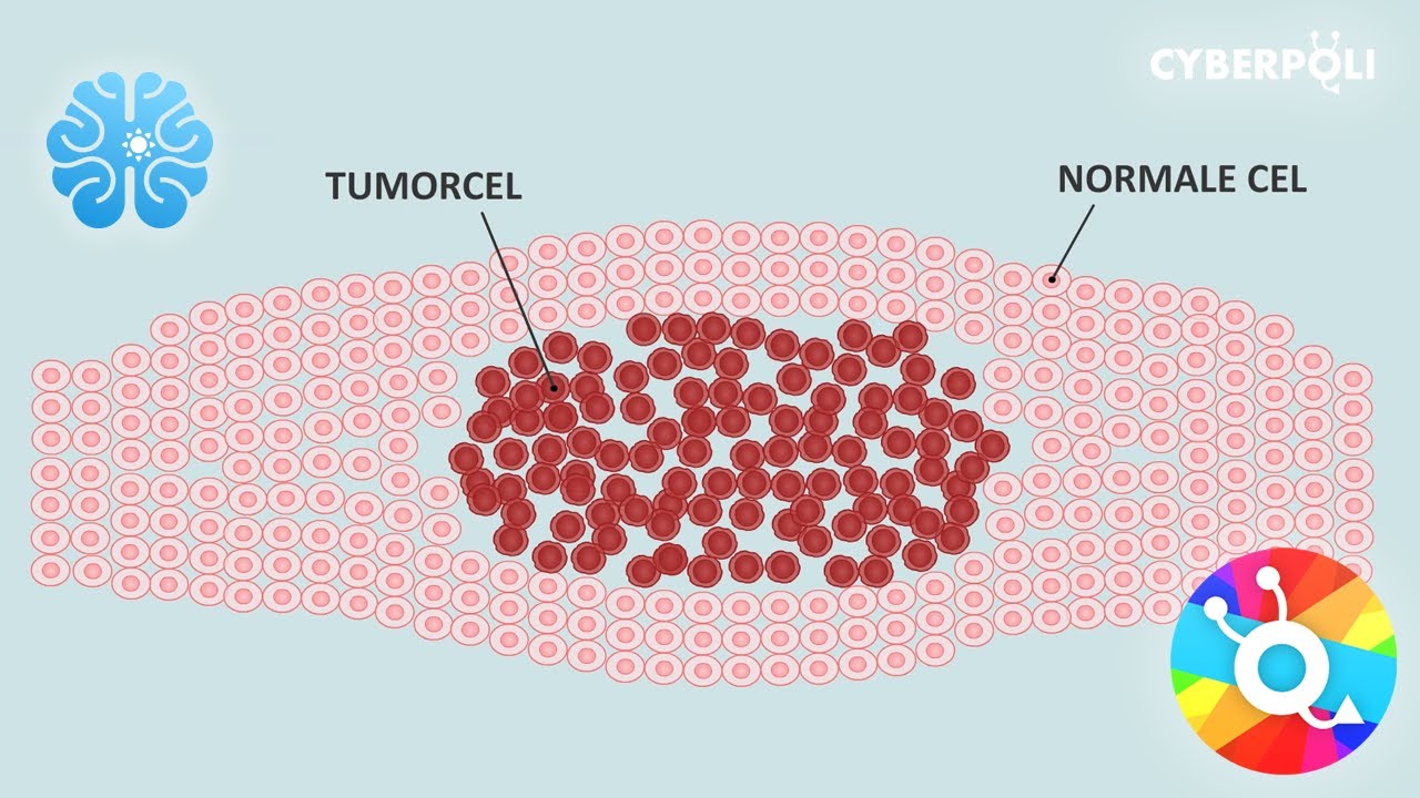 Hersentumoren: Wat is een tumor? - YouTube - Hoe Ziet Een Kwaadaardige Tumor Eruit