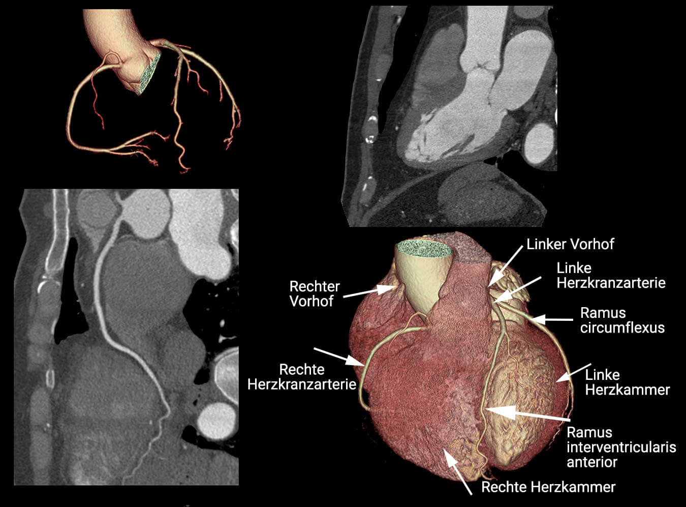 Herz CT: Gründe, Ablauf, Auswertung, Kosten | praktischArzt - Ct Scan Van Het Hoofd