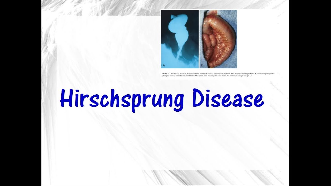 Hirschsprung disease - YouTube - Ziekte Van Hirschsprung Op Latere Leeftijd