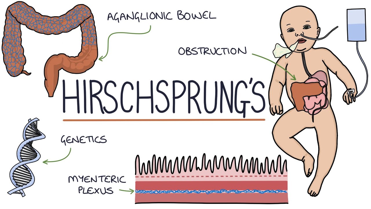 Hirschsprung's Disease - YouTube - Ziekte Van Hirschsprung Op Latere Leeftijd