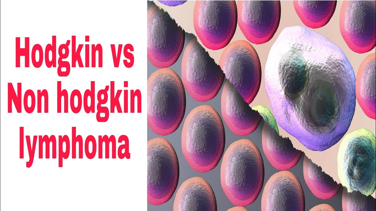 Hodgkin vs Non hodgkin lymphoma | Diffrence... Part. 6 - YouTube - Verschil Hodgkin En Non Hodgkin