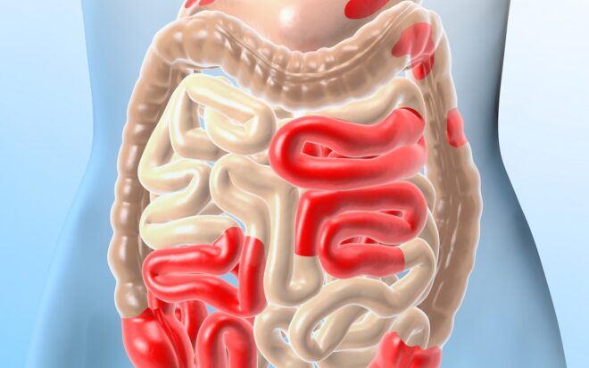 Ziekte Van Crohn En Colitis Ulcerosa