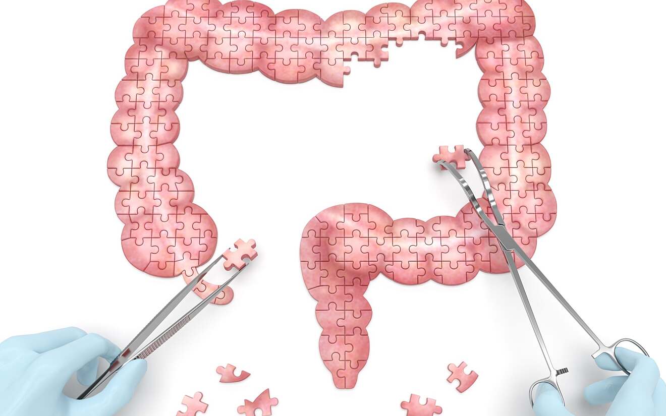 Hoe verloopt de ziekte van Crohn en colitis ulcerosa - Ziekte Van Crohn En Colitis Ulcerosa