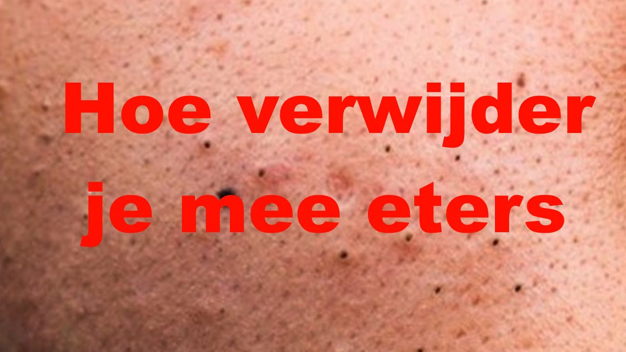 Hoe verwijder je mee eters - YouTube - Rode Bult Met Zwart Puntje