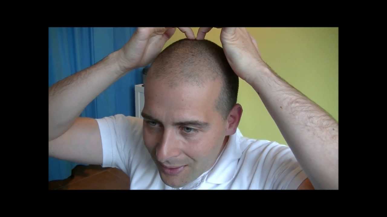 Hoofdpijn bovenop je hoofd? Bekijk deze laatste video over hoofdpijn en - Pijn Bovenop Hoofd Bij Aanraking