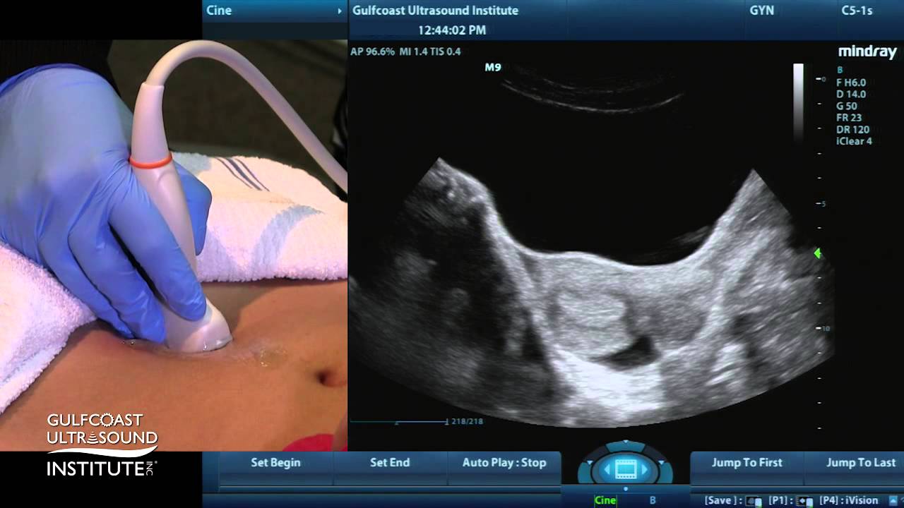 Hot Tip - Fluid in the Pouch of Douglas - YouTube - Cavum Douglasi Spoortje Vrij Vocht
