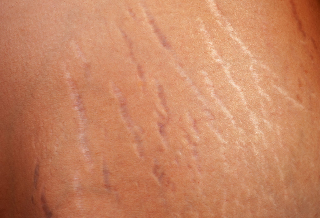 How Do Stretch Marks Happen? - Spa MD - Wat Te Doen Tegen Striae Oma Weet Raadt