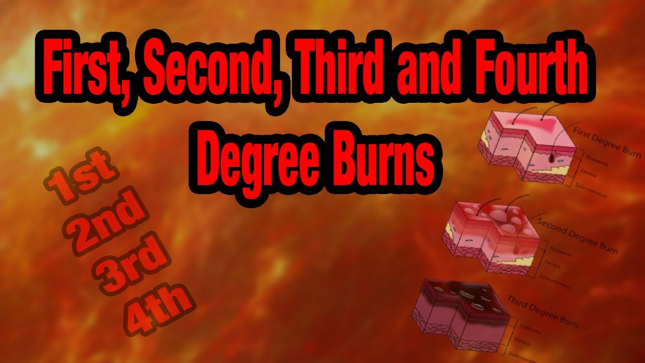How To Grade BURNS - 1st, 2nd, 3rd and 4th Degree Burns Explained - YouTube - 1e 2e 3e Graads Brandwond