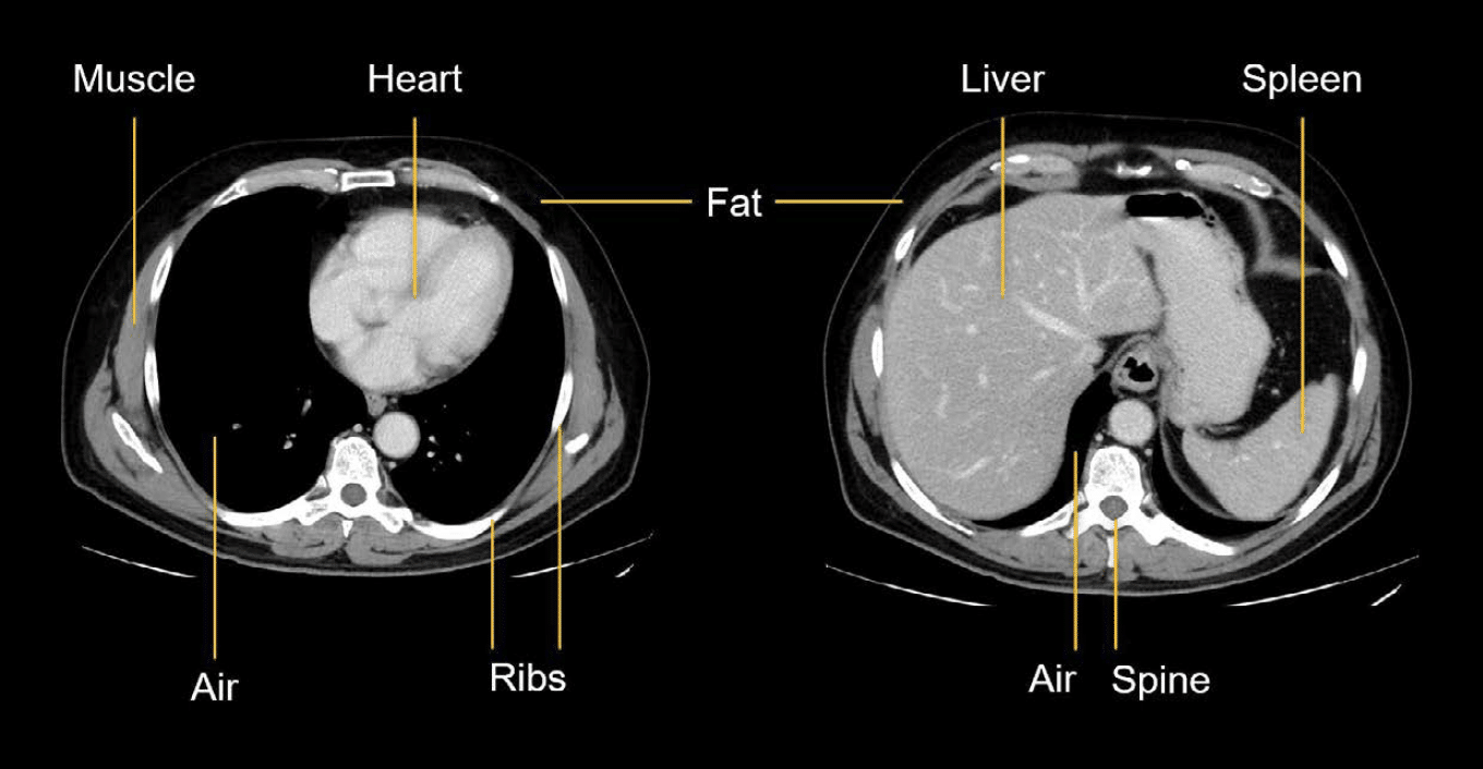How To Read Ct Scan Ct Abdomen Faculty Of Medicine – Bilarasa - Ct Scan Longen Met Contrastvloeistof