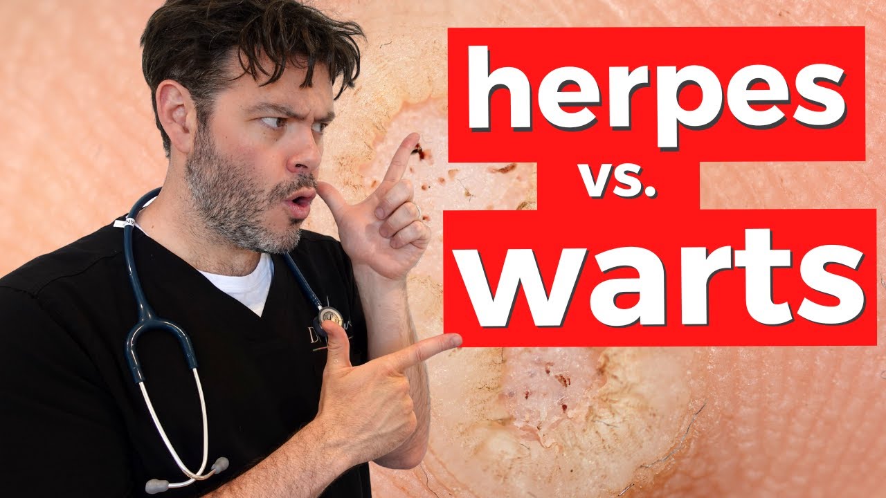 How to tell genital herpes from warts - YouTube - Hoe Lang Is Herpes Besmettelijk
