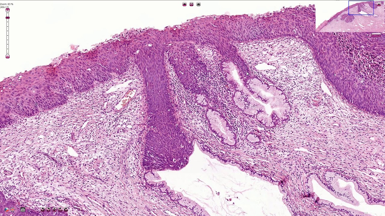 HSIL - High Grade Squamous Intraepithelial Lesion - Histopathology - Bethesda Negatief Voor Intra Epitheliale Neoplasie