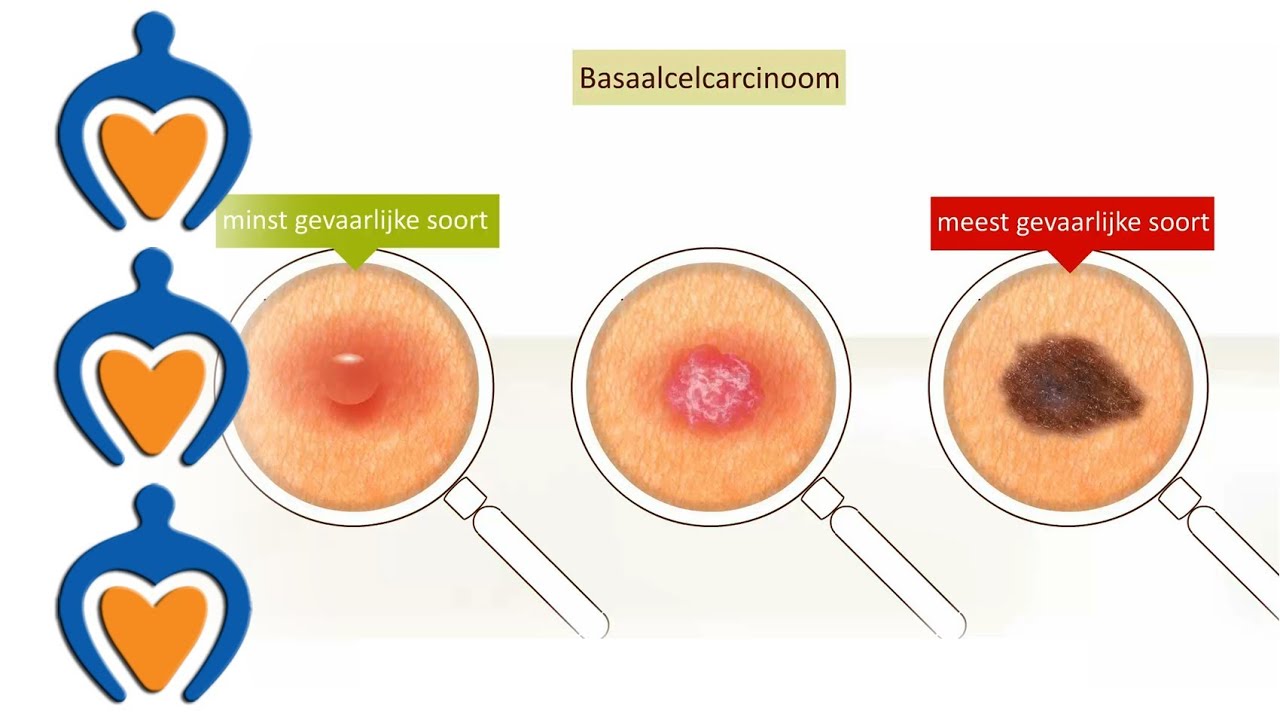 Huidkanker - Basaalcelcarcinoom (video 2 van 5) - YouTube - Hoe Voelt Een Kwaadaardig Knobbeltje Oksel