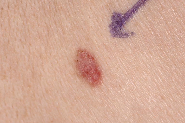 Huidkanker – Medisch Schoonheidsspecialist Dermatologie® - Hoe Ziet Een Huidkanker Plekje Eruit