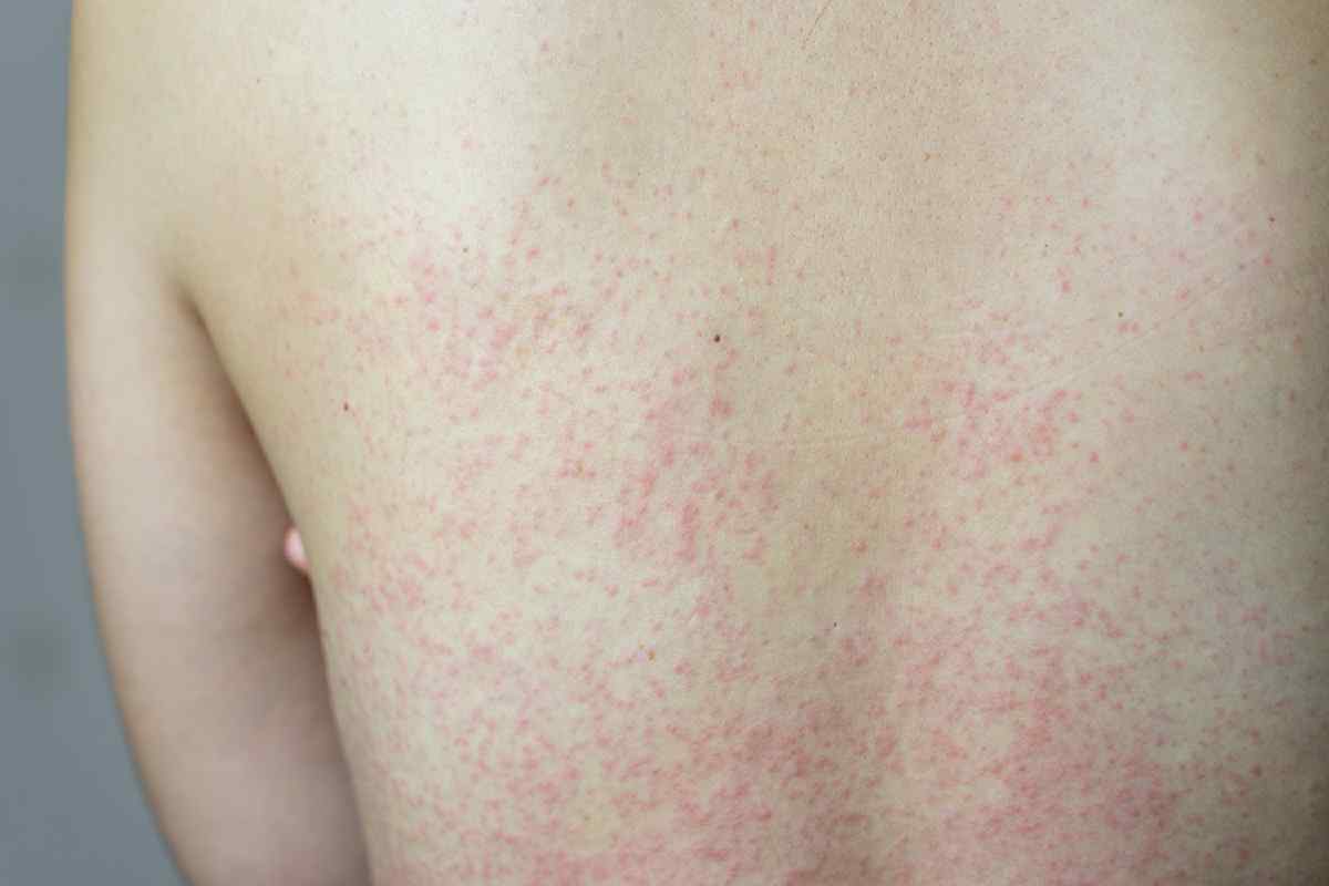 Huidklachten bij de ziekte van Crohn | IBD De Baas - Ziekte Van Waldenstrom In Het Laatste Stadium