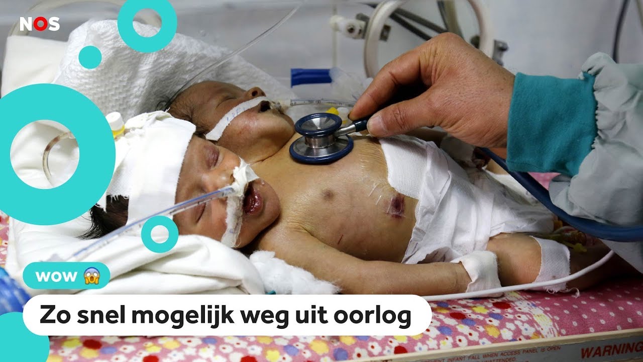 Hulp voor Siamese tweeling in oorlogsgebied - YouTube - Hoeveel Tweelingen Zijn Er In Nederland