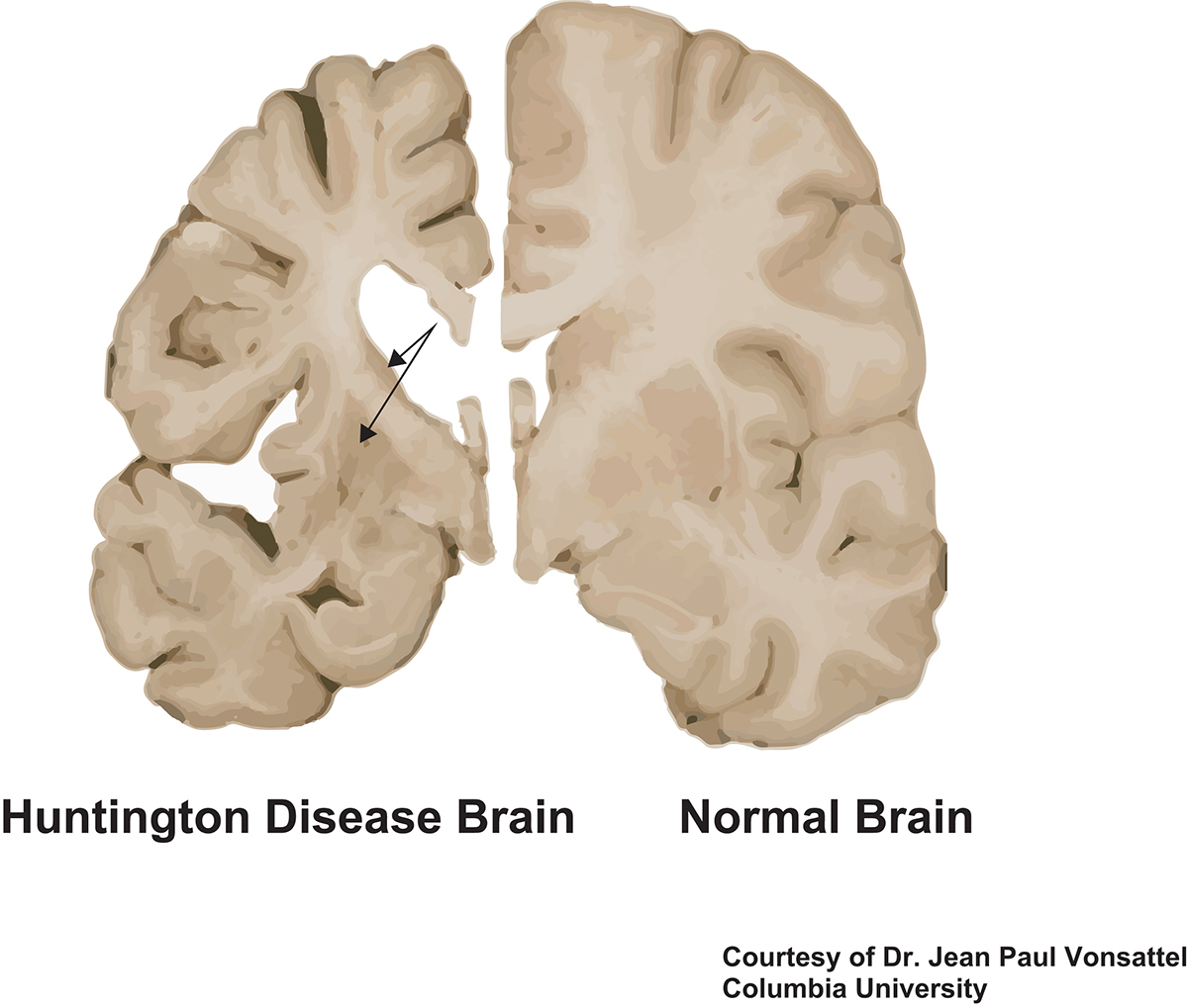 Huntington’s disease (HD) research - Huntington Combinatie Van 3 Ziektes