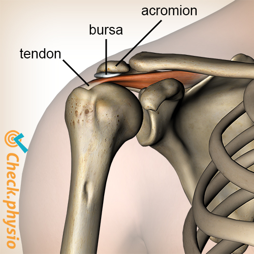Impingement syndrome | Physio Check - Kngf Evidence Statement Subacromiale Klachten