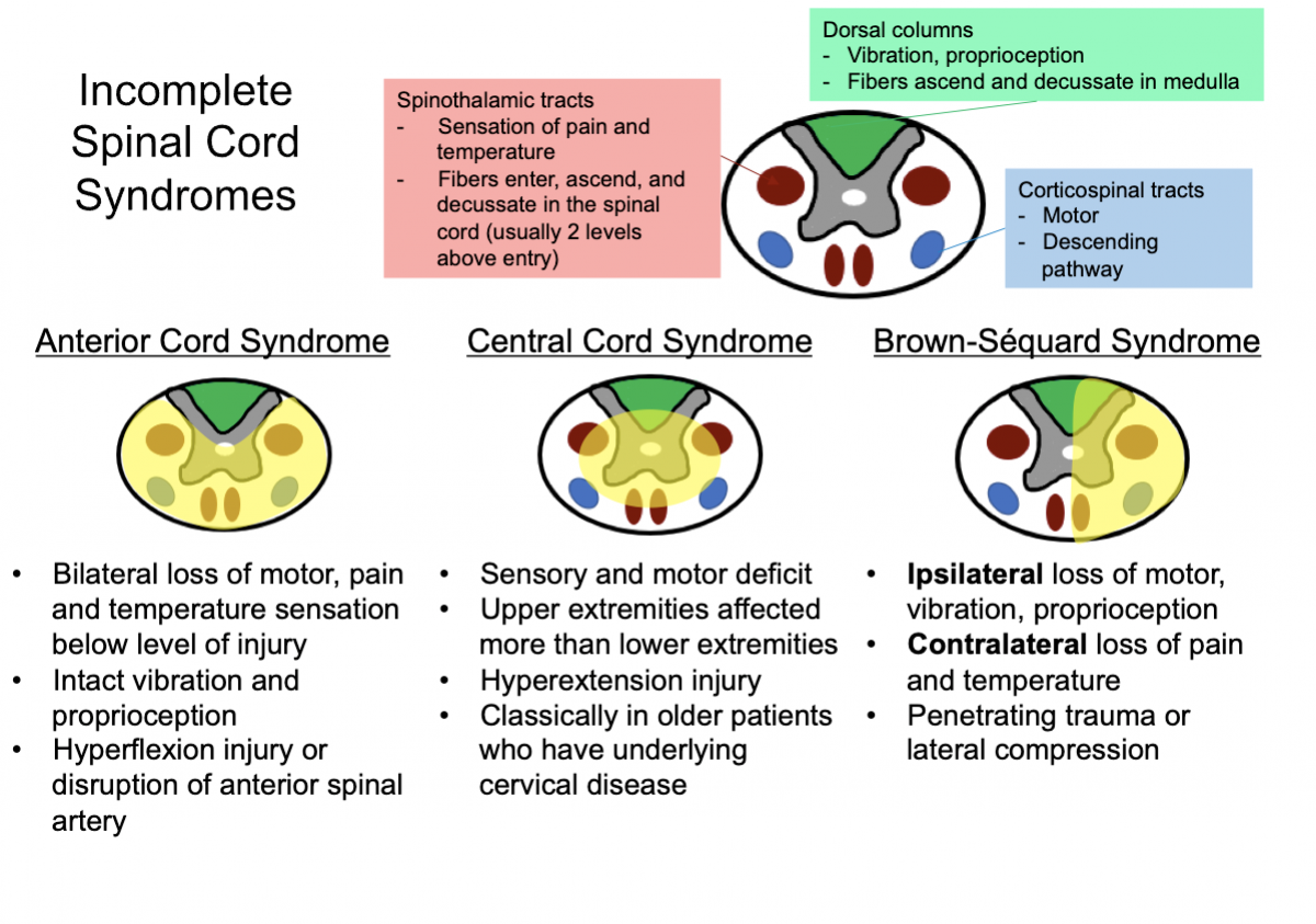 Incomplete Spinal Cord Syndromes Anterior Cord Syndrome: | Spinal - Wat Is Een Incomplete Dwarslaesie