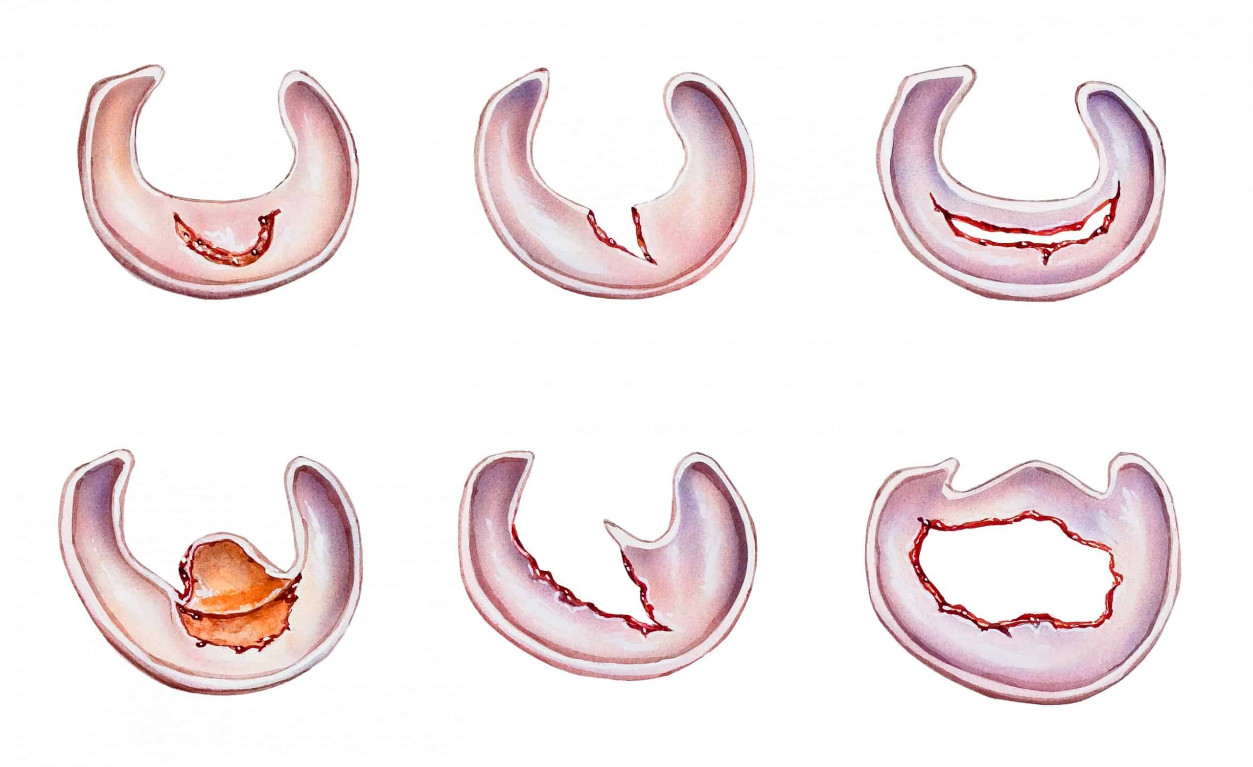 Informatie over een gescheurde meniscus - Kniecare - Horizontale Scheur Achterhoorn Mediale Meniscus
