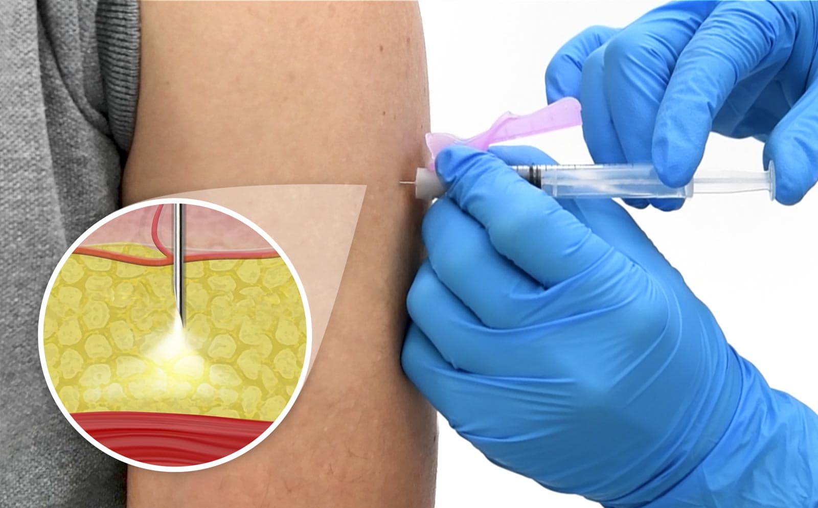 Hoeveel Milliliter Vloeistof Kun Je Maximaal Per Keer Subcutaan Injecteren