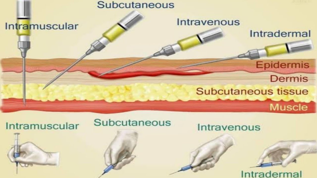 Injection Techniques | Intramuscular | Intravenous | Intradermal - Meest Gebruikte Techniek Subcutaan Injecteren