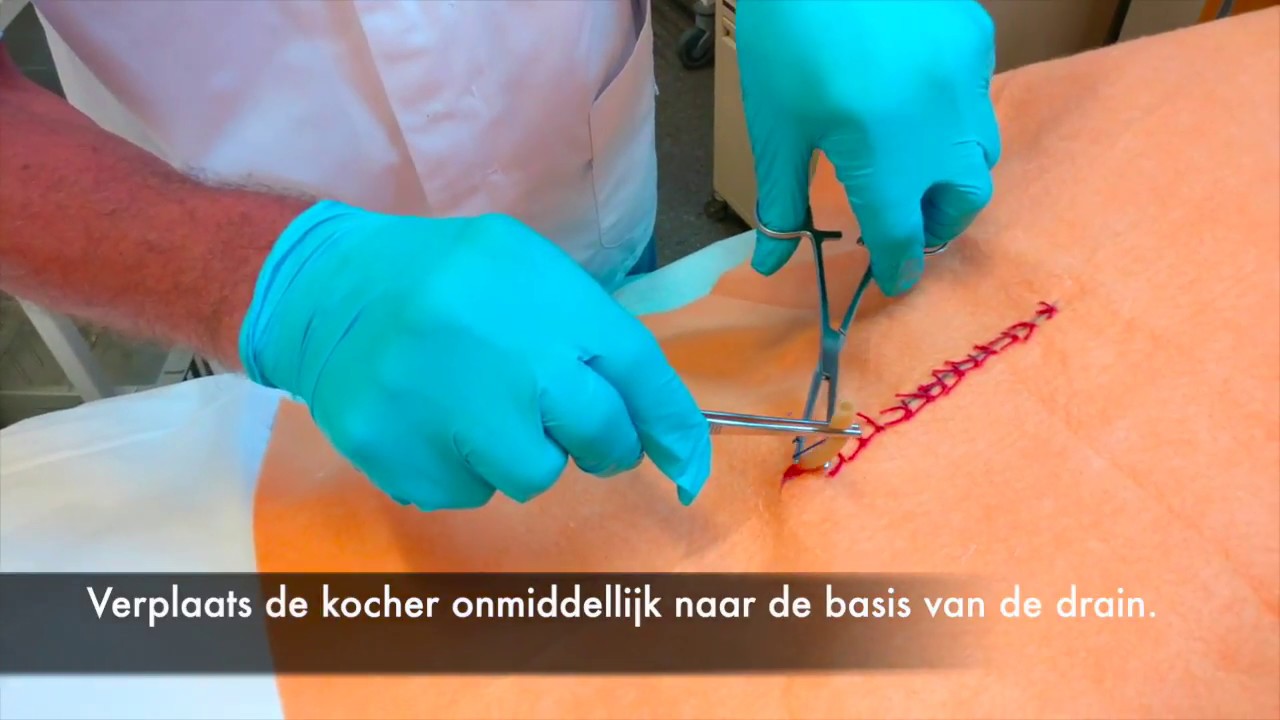 Inkorten van een eindstandige wonddrain - YouTube - Hoe Weet Je Of Een Wond Geinfecteerd Is