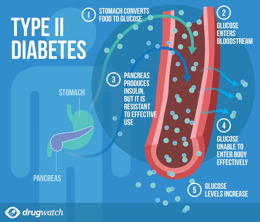 Diabetes Mellitus Type 2 Diagnose