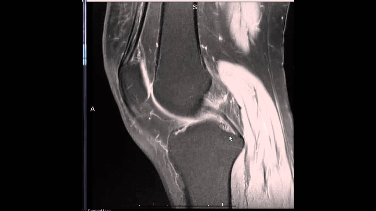 Introduction to reading a Knee MRI - YouTube - Wat Zie Je Op Een Mri Scan