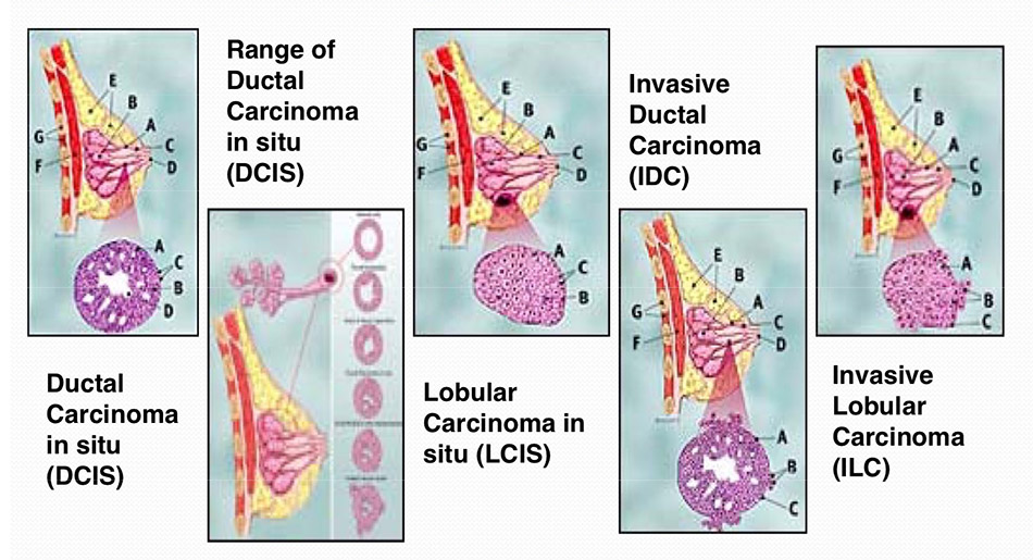 Invasive Lobular Carcinoma - Invasief Lobulair Carcinoom Graad 2