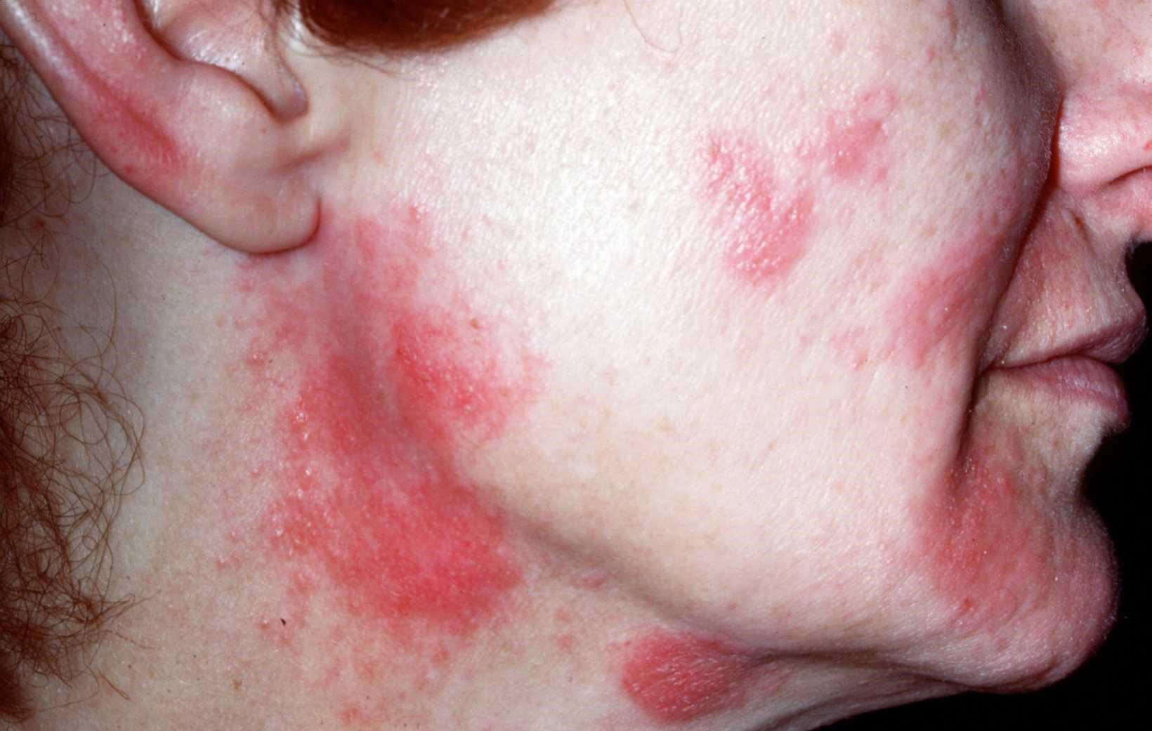 itchy spots on back - pictures, photos - Witte Vlekjes Op Huid Schimmel