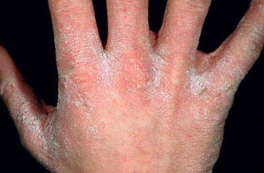 ivermectin scabies - pictures, photos - Hoe Lang Is Influenza Besmettelijk
