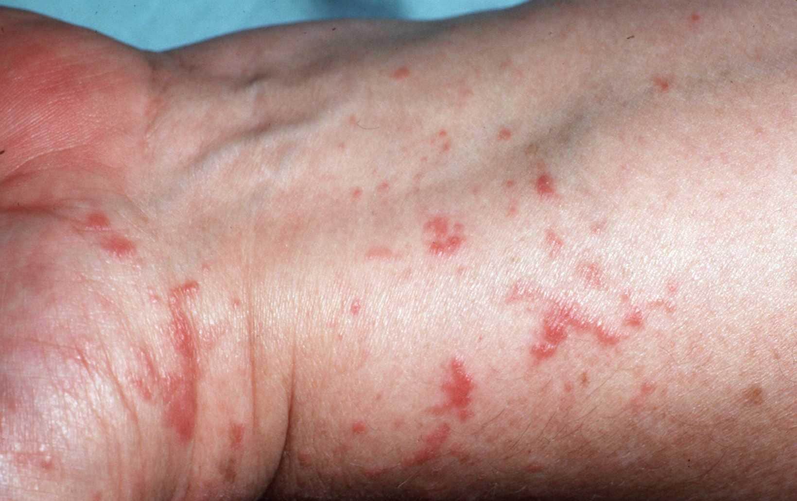Jeukende Opgezette Tattoos - Rode Vlekken Schurft Of Eczeem