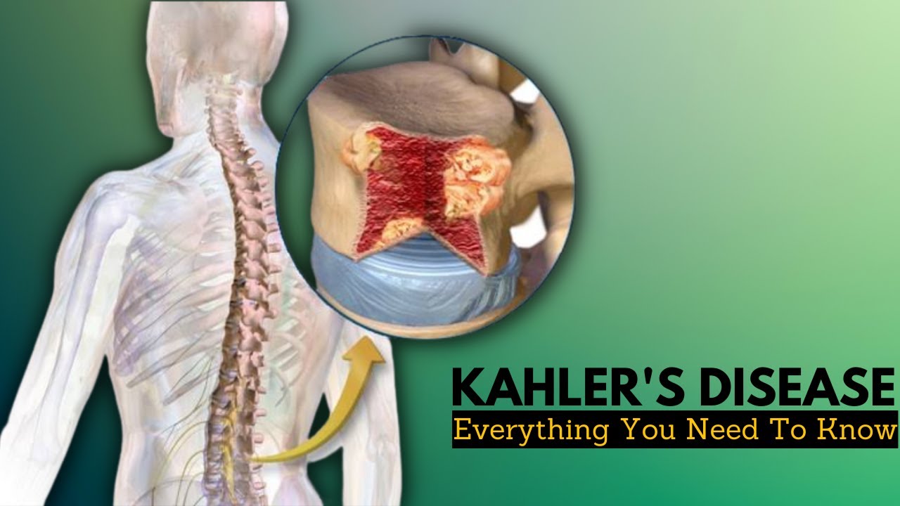 Kahler's Disease, Causes, Signs and Symptoms, Diagnosis and Treatment - Ziekte Van Kahler Wat Is Dat